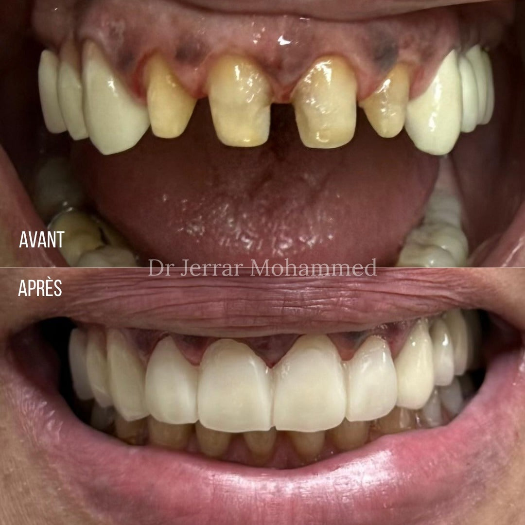 Avant et après : réhabilitation complète du sourire